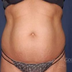 Abdominoplasty - With Liposuction of The Waist Before & After Patient #1398