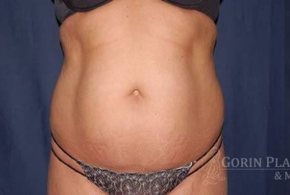 Abdominoplasty - With Liposuction of The Waist Before & After Patient #1398