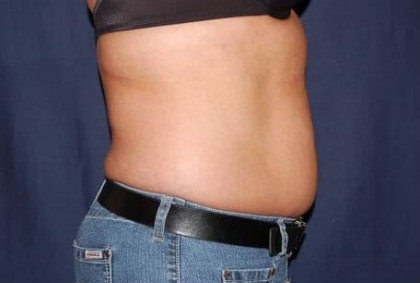 Abdominoplasty - With Liposuction of The Waist Before & After Patient #1398