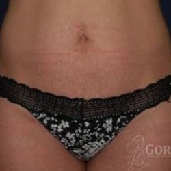 Abdominoplasty - With Liposuction of The Waist Before & After Patient #1404