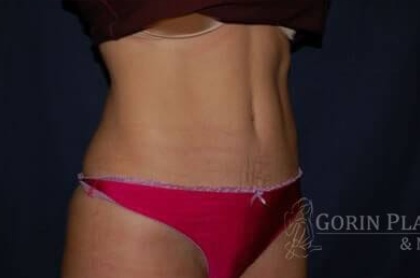 Abdominoplasty - With Liposuction of The Waist Before & After Patient #1404