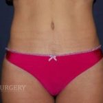 Abdominoplasty - With Liposuction of The Waist Before & After Patient #1404