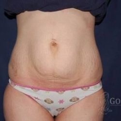 Abdominoplasty - With Liposuction of The Waist Before & After Patient #1408