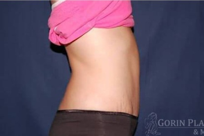 Abdominoplasty - With Liposuction of The Waist Before & After Patient #1408