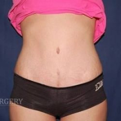 Abdominoplasty - With Liposuction of The Waist Before & After Patient #1408
