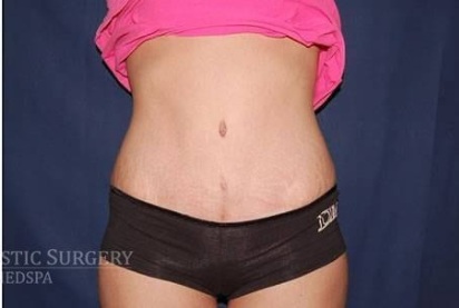 Abdominoplasty - With Liposuction of The Waist Before & After Patient #1408