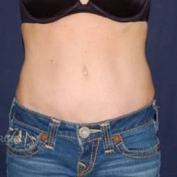 Abdominoplasty - With Liposuction of The Waist Before & After Patient #1414