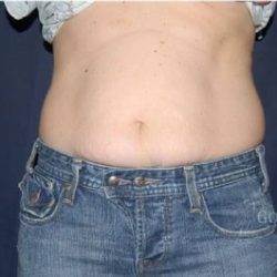 Abdominoplasty - With Liposuction of The Waist Before & After Patient #1414