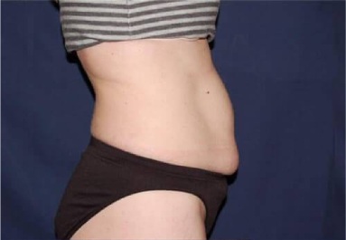 Abdominoplasty - With Liposuction of The Waist Before & After Patient #1414