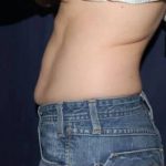 Abdominoplasty - With Liposuction of The Waist Before & After Patient #1414