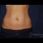 Abdominoplasty - With Liposuction of The Waist Before & After Patient #1420