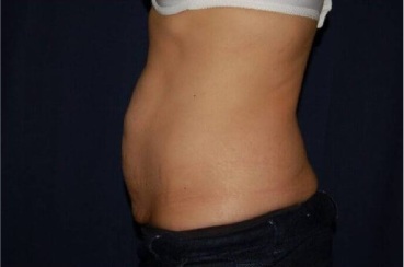 Abdominoplasty - With Liposuction of The Waist Before & After Patient #1420