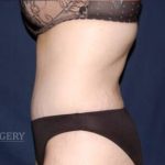 Abdominoplasty - With Liposuction of The Waist Before & After Patient #1424