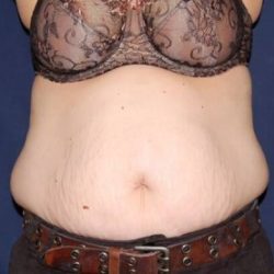 Abdominoplasty - With Liposuction of The Waist Before & After Patient #1424