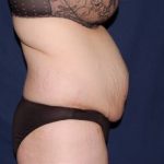Abdominoplasty - With Liposuction of The Waist Before & After Patient #1424