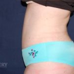 Abdominoplasty - With Liposuction of The Waist Before & After Patient #1428