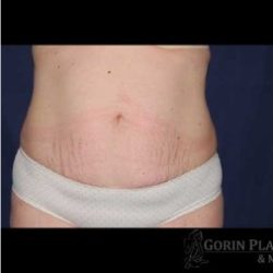 Abdominoplasty - With Liposuction of The Waist Before & After Patient #1428