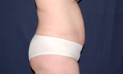 Abdominoplasty - With Liposuction of The Waist Before & After Patient #1428