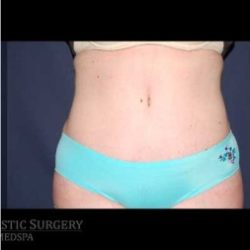 Abdominoplasty - With Liposuction of The Waist Before & After Patient #1428