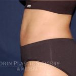 Abdominoplasty - With Liposuction of The Waist Before & After Patient #1433