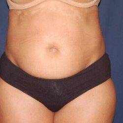Abdominoplasty - With Liposuction of The Waist Before & After Patient #1433