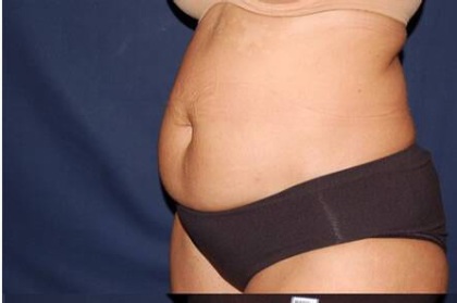 Abdominoplasty - With Liposuction of The Waist Before & After Patient #1433