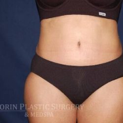 Abdominoplasty - With Liposuction of The Waist Before & After Patient #1433