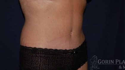 Abdominoplasty - With Liposuction of The Waist Before & After Patient #1437
