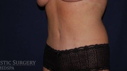 Abdominoplasty - With Liposuction of The Waist Before & After Patient #1437