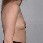 Breast Enlargement Before & After Patient #997
