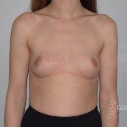Breast Enlargement Before & After Patient #997