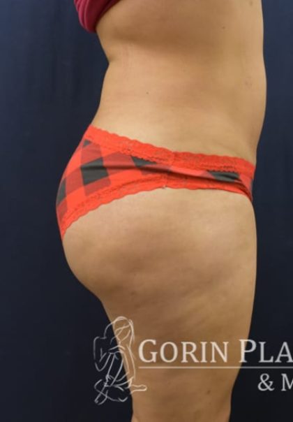 Brazilian Butt Lift Before & After Patient #1149