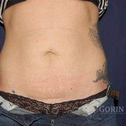 Abdominoplasty - With Liposuction of The Waist Before & After Patient #1335