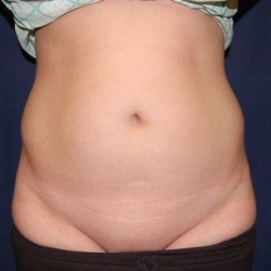 Liposuction Before & After Patient #1245