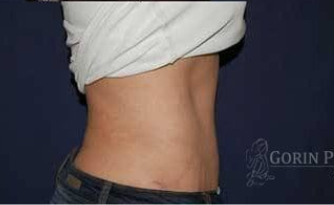 Abdominoplasty - With Liposuction of The Waist Before & After Patient #1339