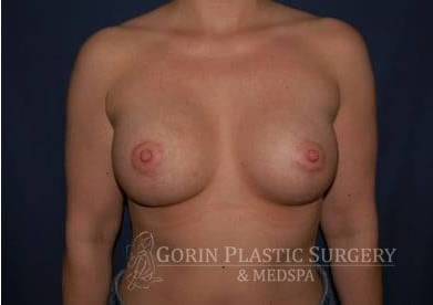 Breast Lift With Implants Before & After Patient #1249