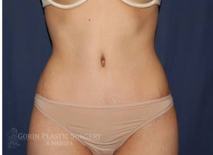 Abdominoplasty - With Liposuction of The Waist Before & After Patient #1384