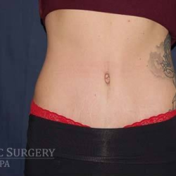 Abdominoplasty - With Liposuction of The Waist Before & After Patient #1335