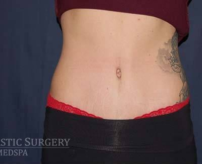 Abdominoplasty - With Liposuction of The Waist Before & After Patient #1335
