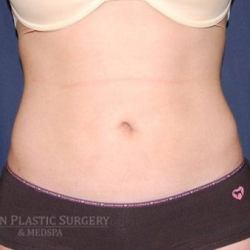 Liposuction Before & After Patient #1245