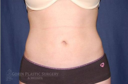 Liposuction Before & After Patient #1245