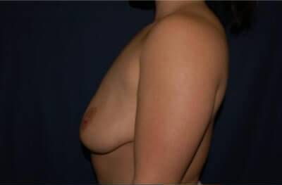 Breast Lift With Implants Before & After Patient #1292