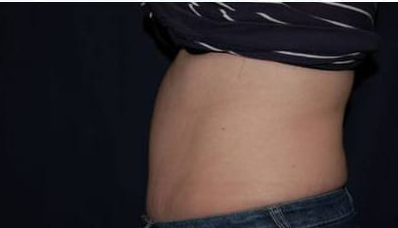 Abdominoplasty - With Liposuction of The Waist Before & After Patient #1389
