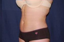 Liposuction Before & After Patient #1245
