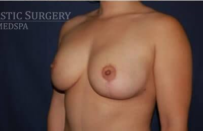Breast Lift With Implants Before & After Patient #1292