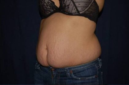 Liposuction Before & After Patient #1460