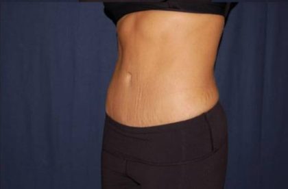 Liposuction Before & After Patient #1460