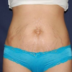 Liposuction Before & After Patient #1461