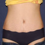 Liposuction Before & After Patient #1461