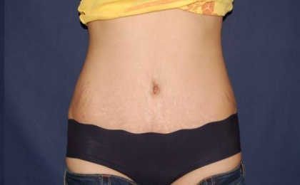 Liposuction Before & After Patient #1461